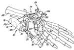 Fixator with Outrigger